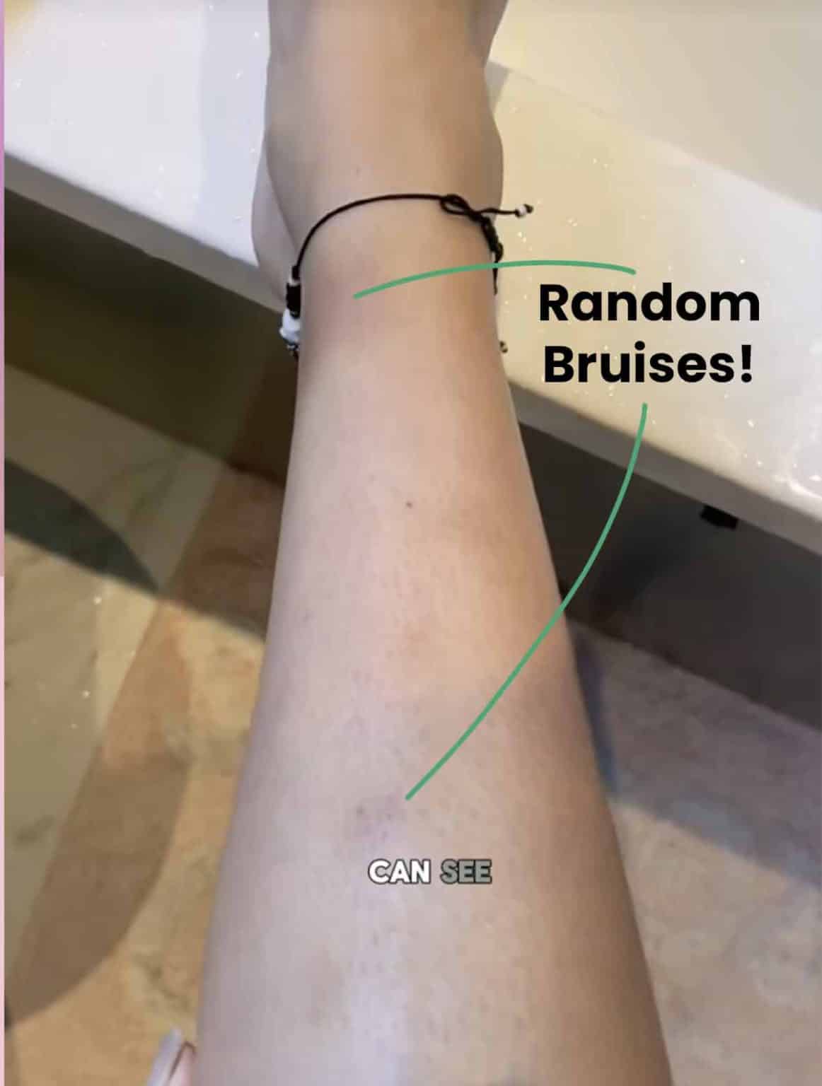 does hrt make you bruise more